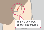 糸をとめるための頭皮が禿げてしまう