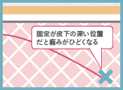 固定が皮下の深い位置だと痛みがひどくなる
