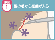 原因1 髪の毛から細菌が入る