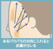 糸をバラバラにいれると皮膚がよれる