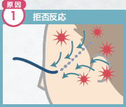原因1 拒否反応