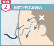 原因2 固定が外れた場合